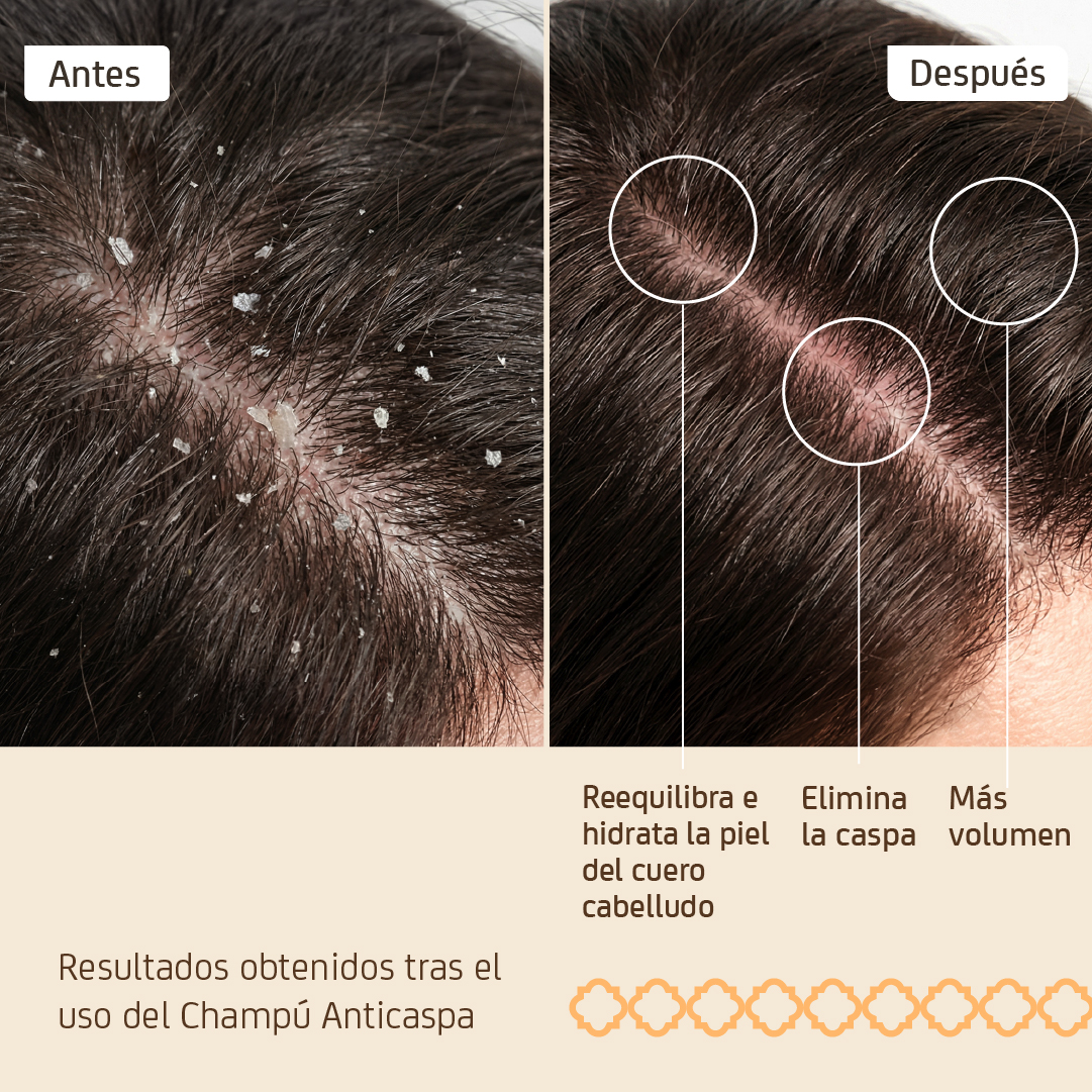 Champú Anti-Caspa - Imagen 3